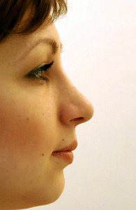 Same patient profile after rhinoplasty