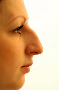 Patient profile before rhinoplasty