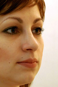 Rhinoplasty result, patient profile view