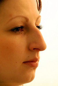 Patient profile before rhinoplasty, alternate angle
