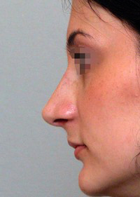 Same patient profile after rhinoplasty
