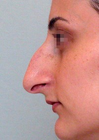 Patient profile before rhinoplasty