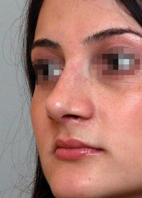Same patient profile after rhinoplasty, alternate angle