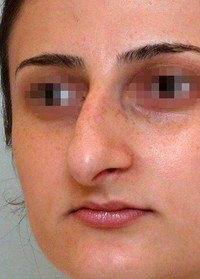 Patient profile before rhinoplasty, alternate angle
