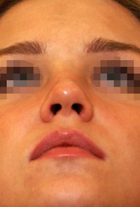 Same patient profile after rhinoplasty