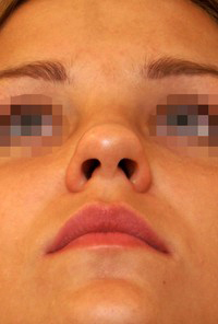 Patient profile before rhinoplasty